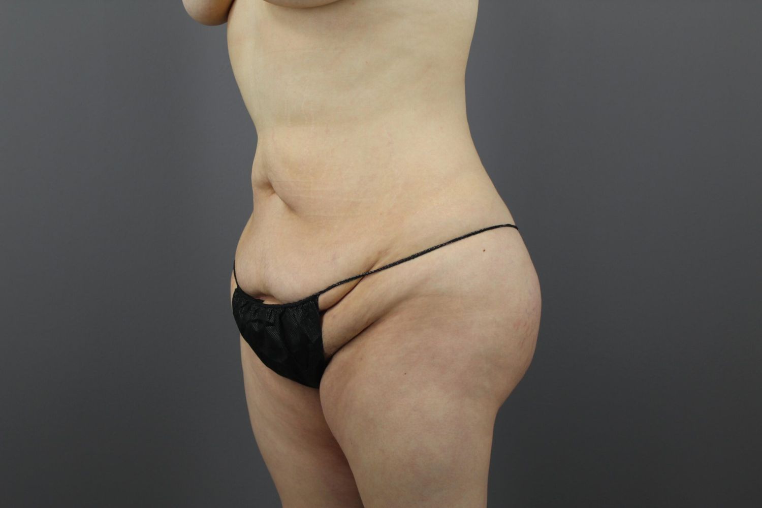 Liposuction Before & After