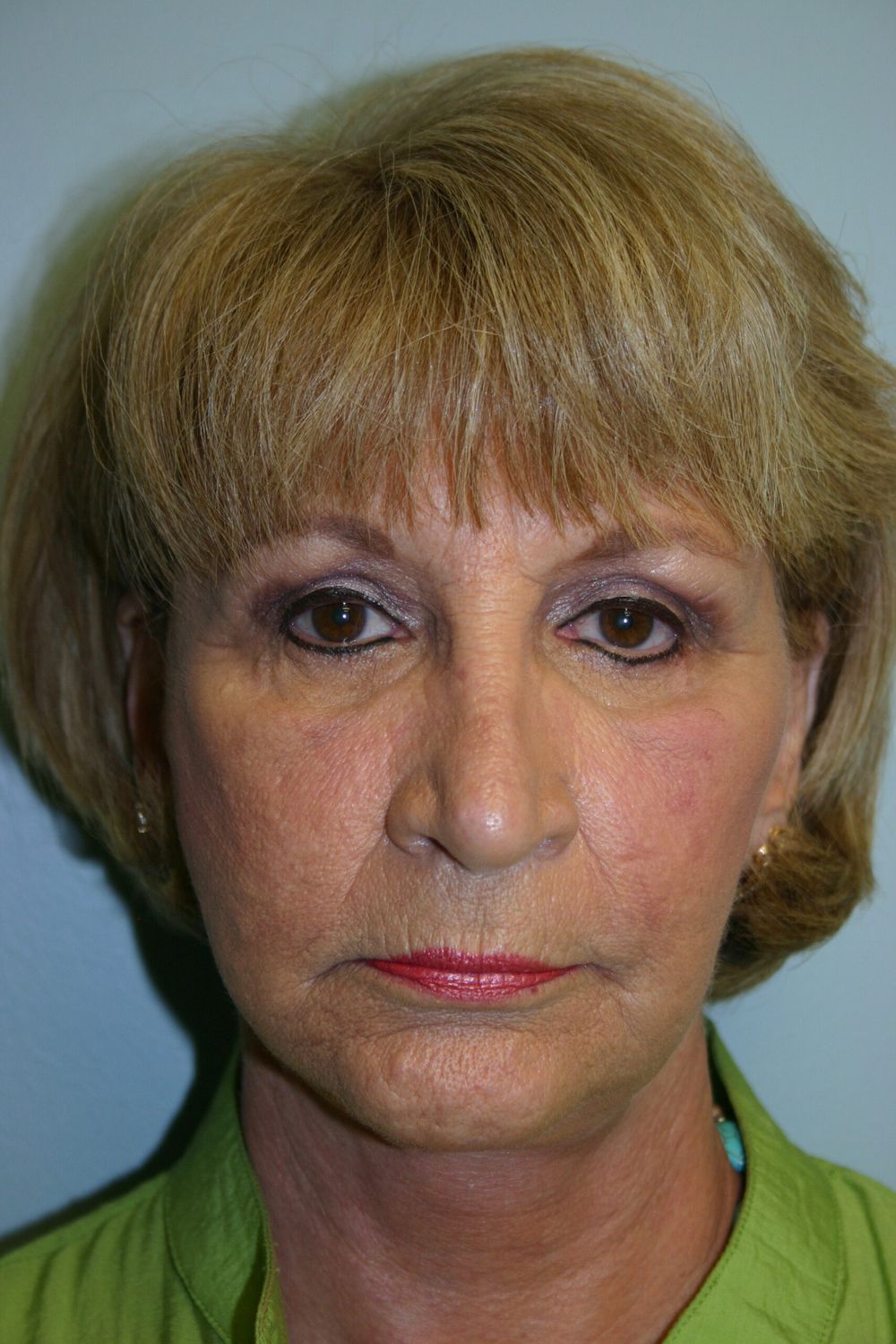 Eyelid Surgery Before & After