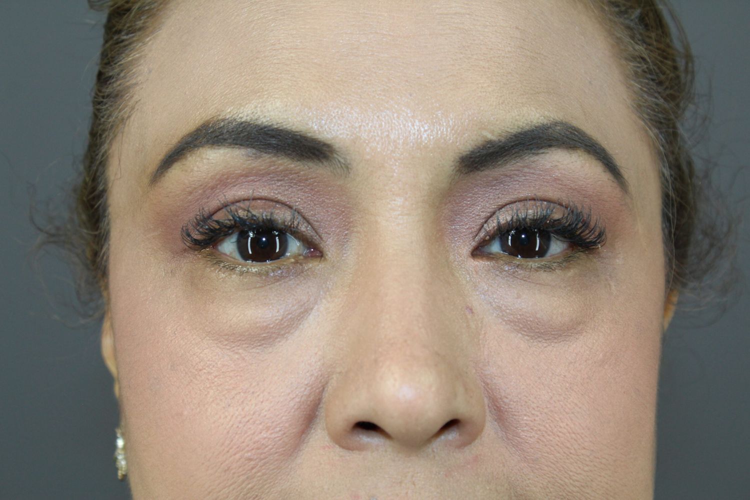 Eyelid Surgery Before & After