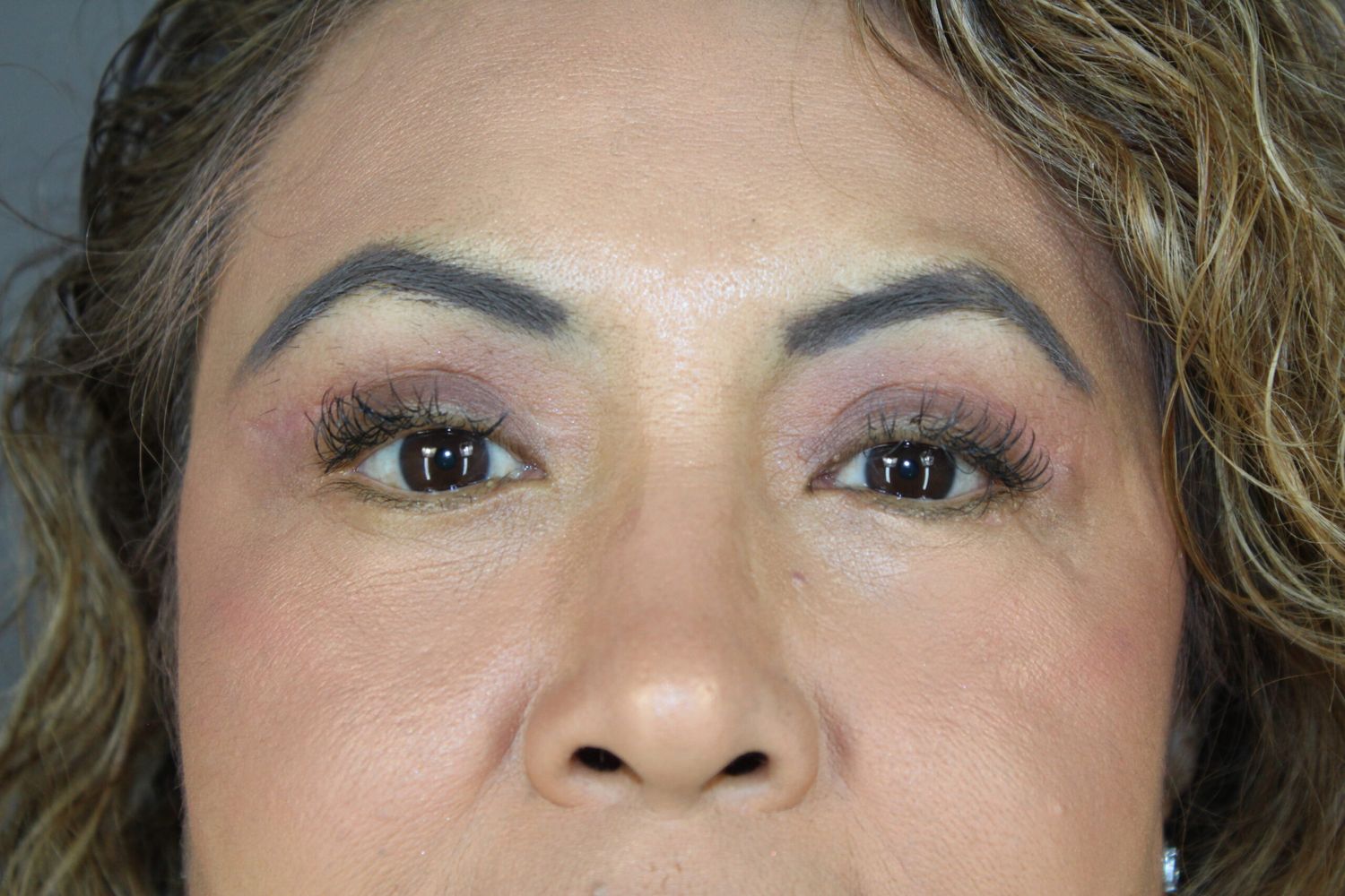 Eyelid Surgery Before & After