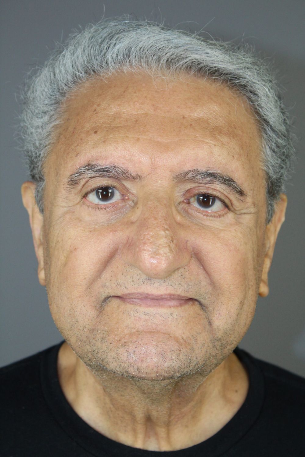 Eyelid Surgery Before & After