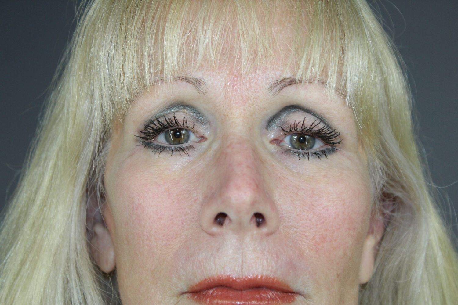 Eyelid Surgery Before & After