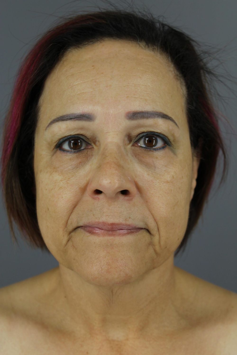 Eyelid Surgery Before & After