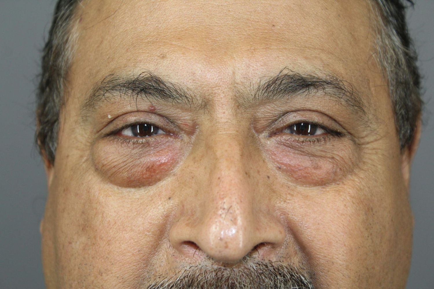 Eyelid Surgery Before & After