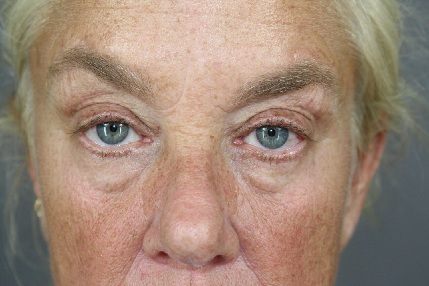 Eyelid Surgery Before & After