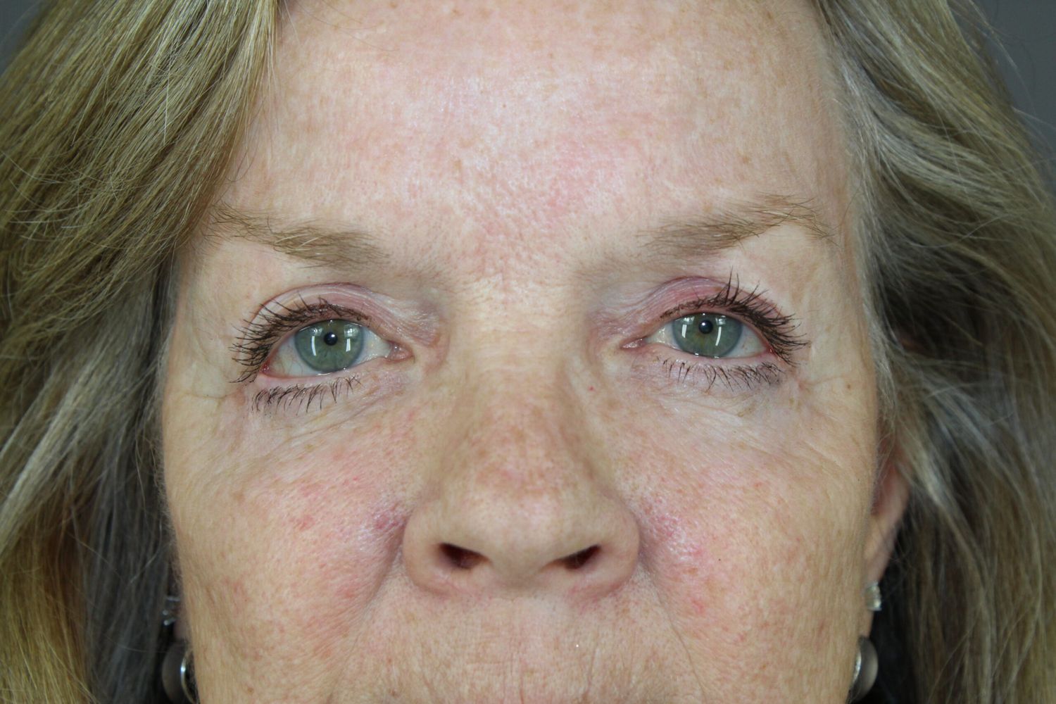 Eyelid Surgery Before & After