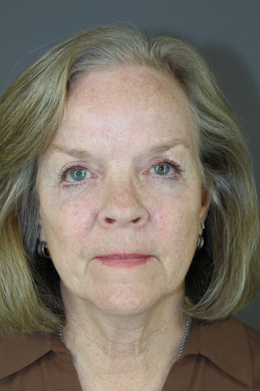 Eyelid Surgery Before & After