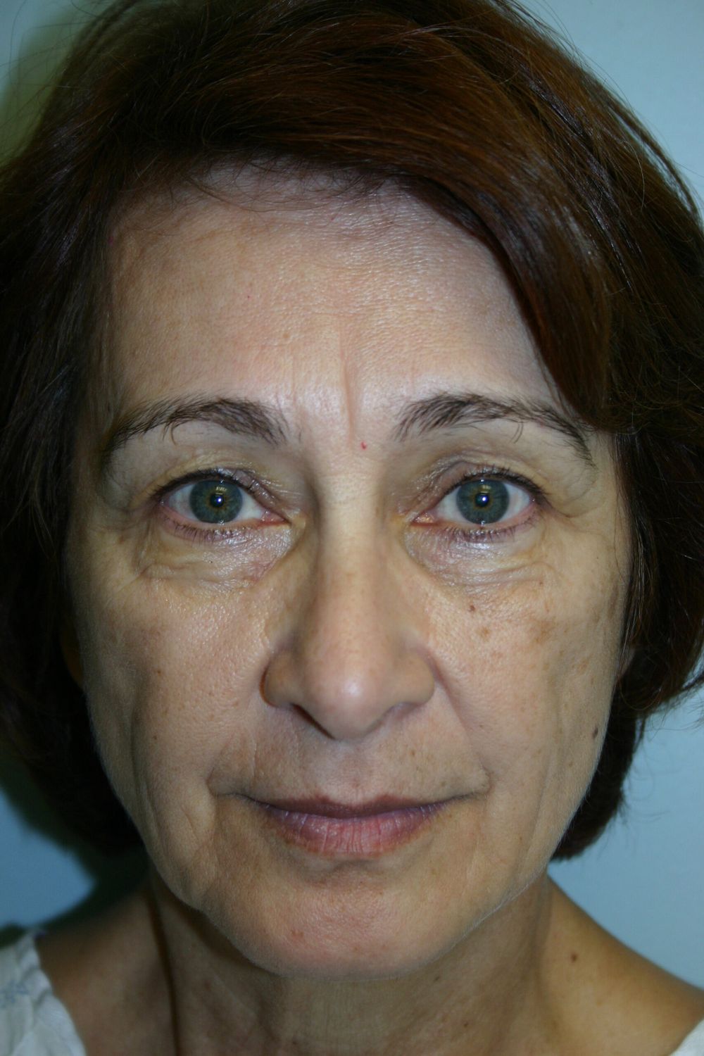 Eyelid Surgery Before & After