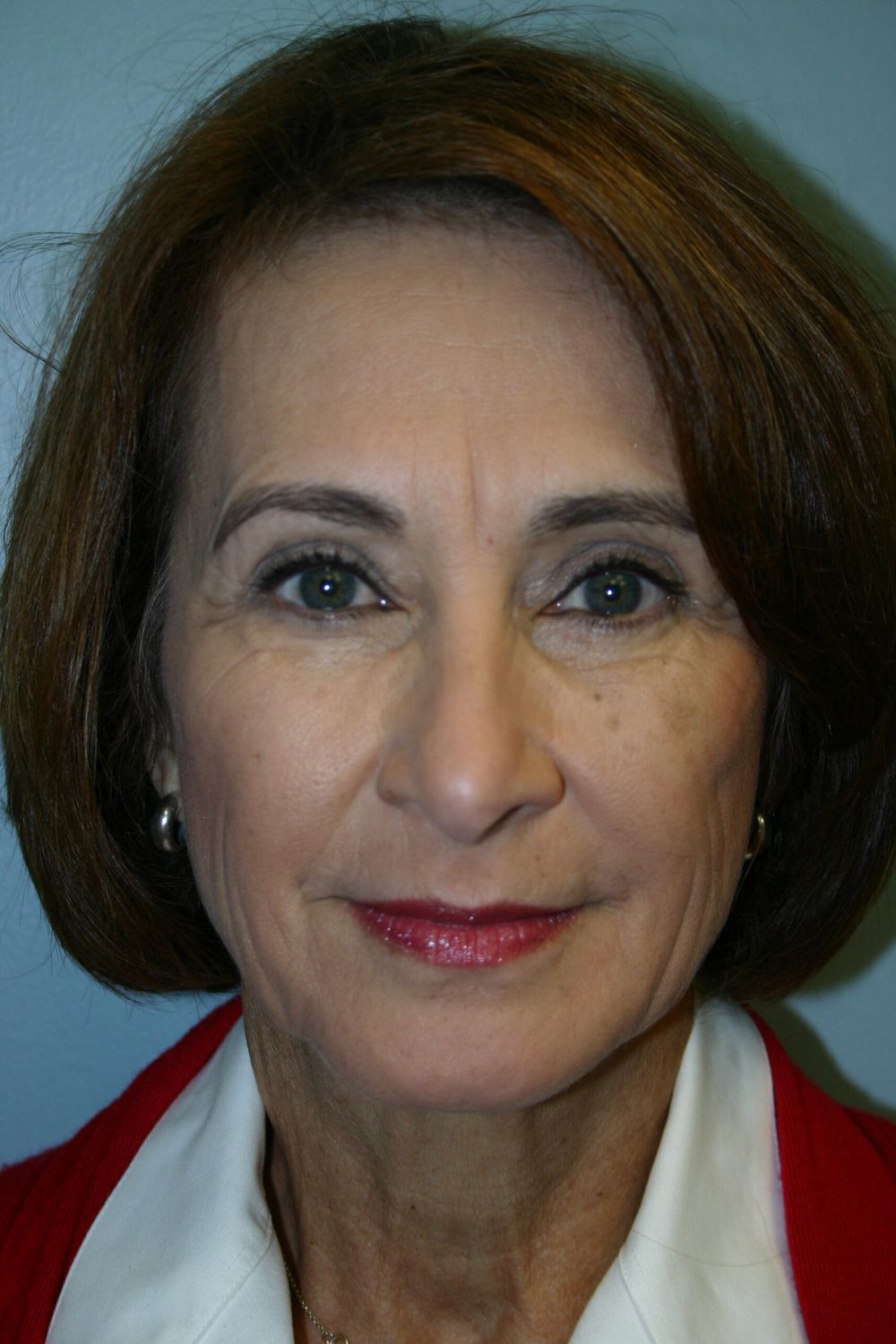 Eyelid Surgery Before & After