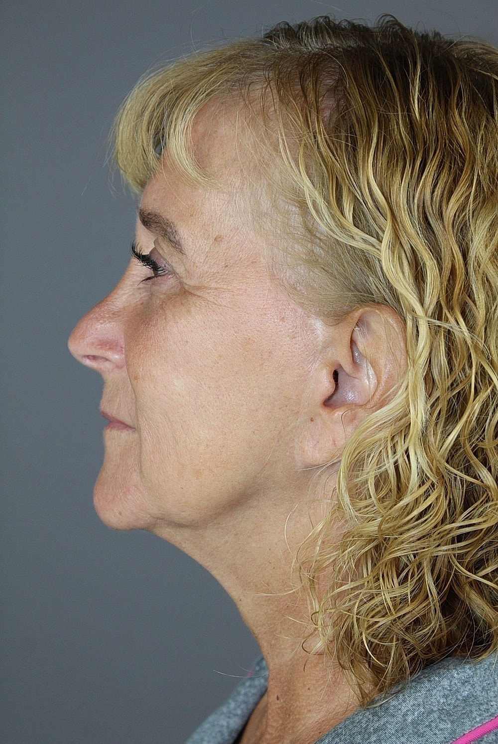 Eyelid Surgery Before & After