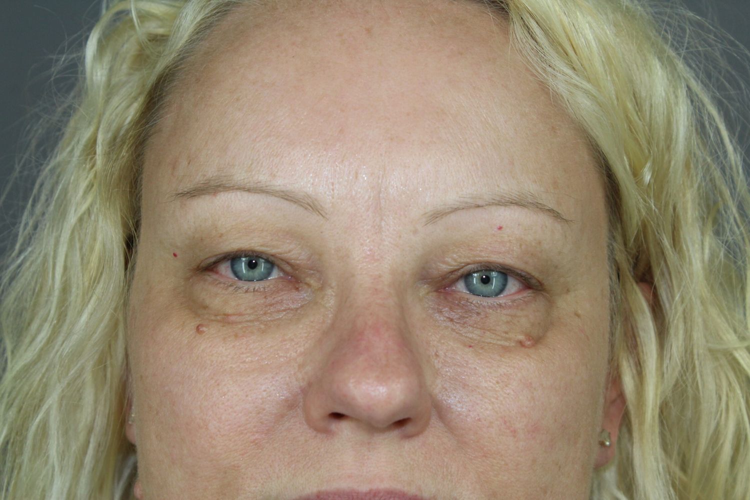 Eyelid Surgery Before & After