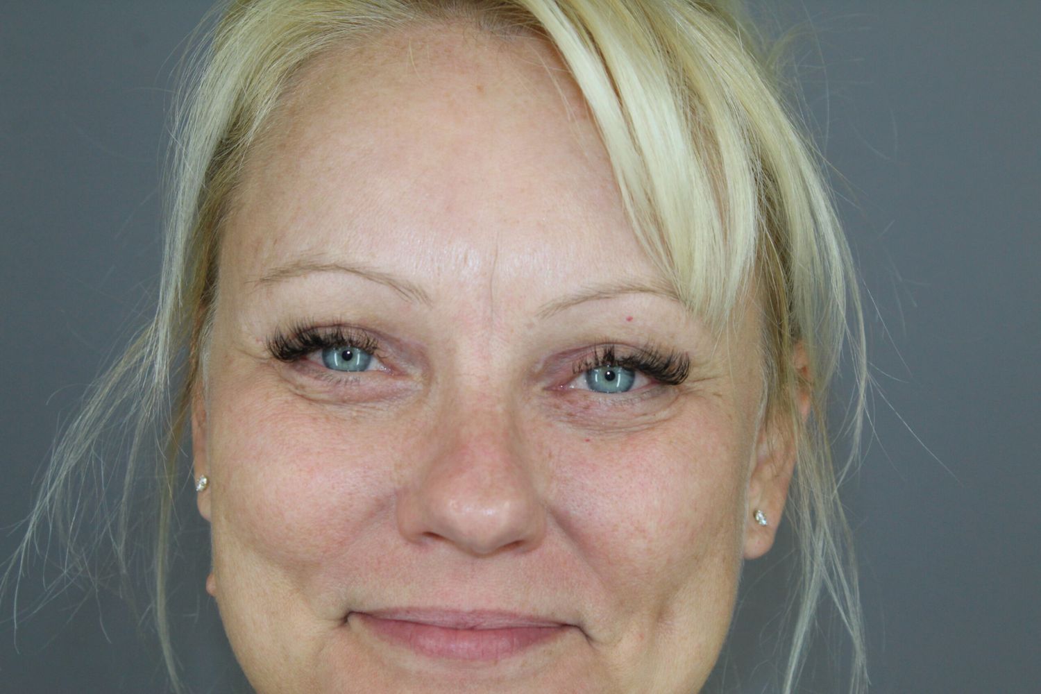 Eyelid Surgery Before & After