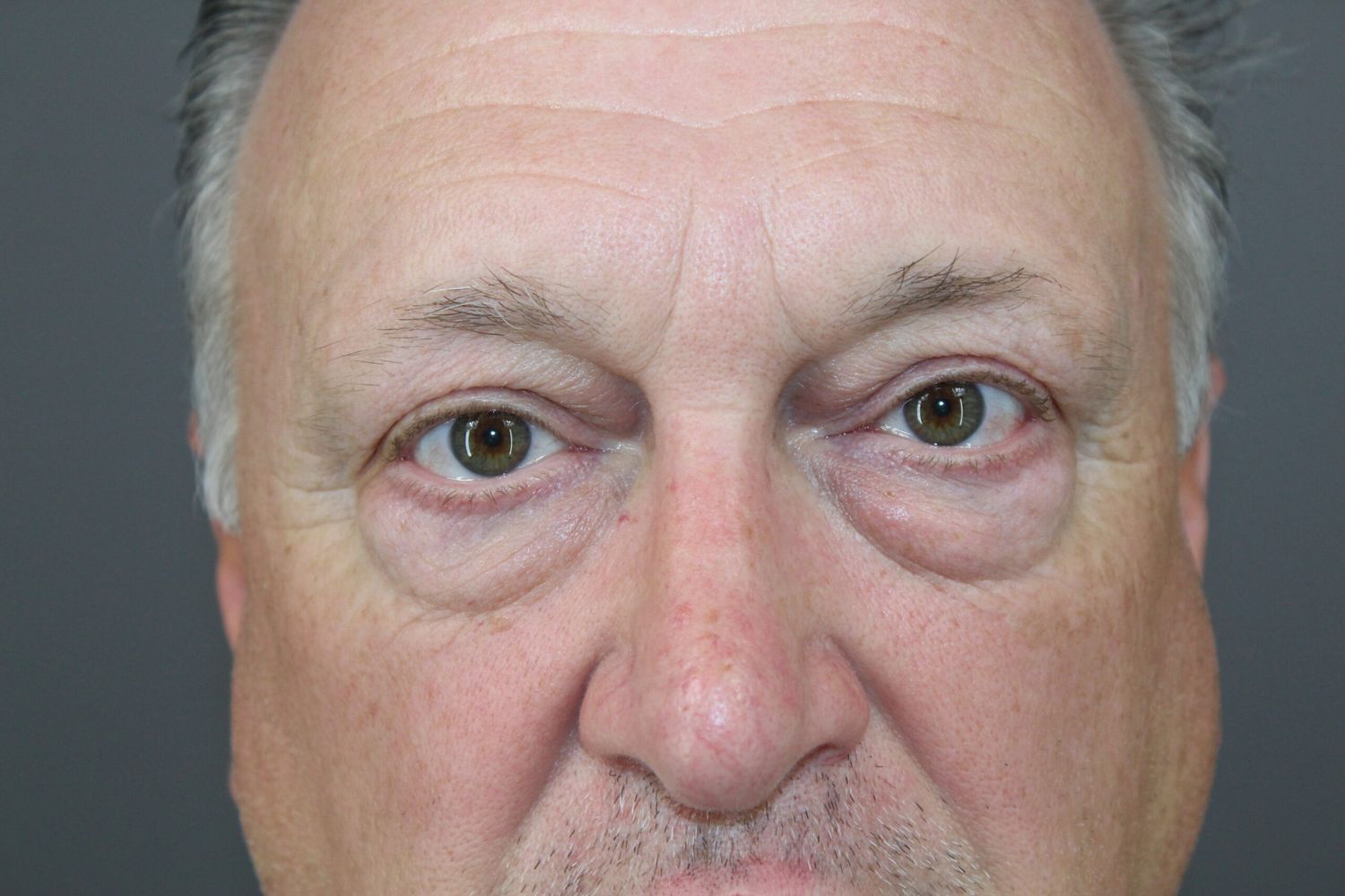 Eyelid Surgery Before & After