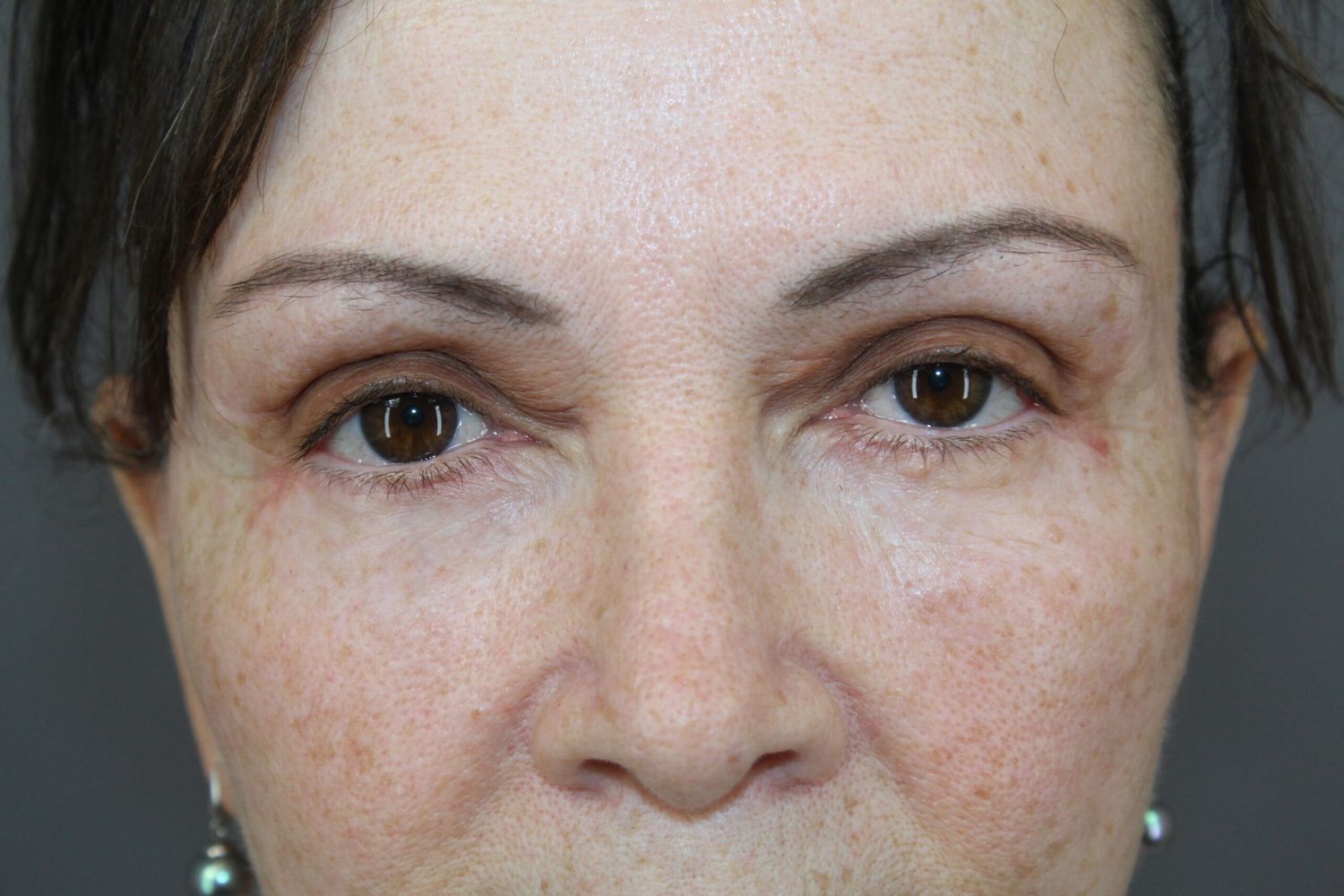 Eyelid Surgery Before & After