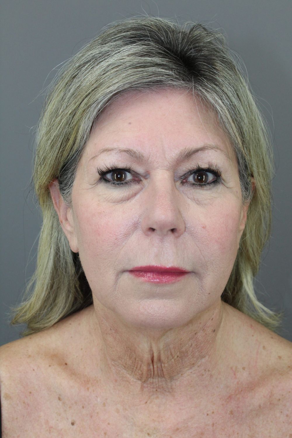 Eyelid Surgery Before & After