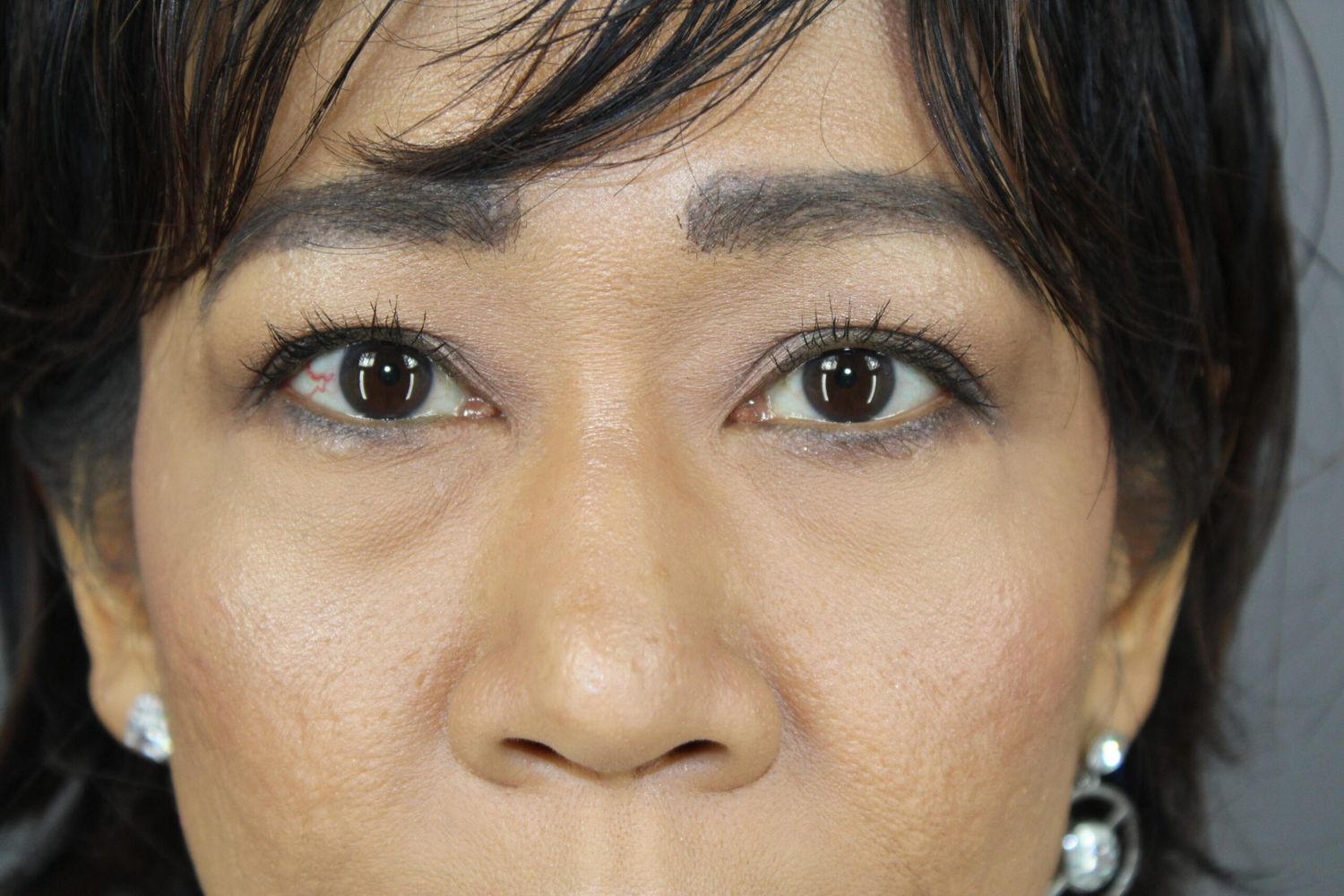 Eyelid Surgery Before & After