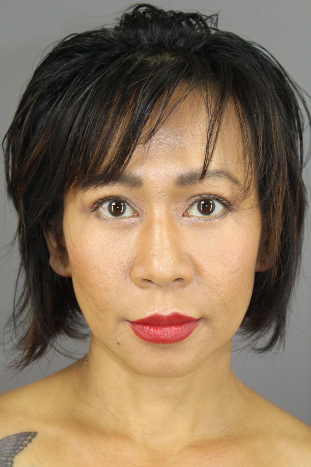 Eyelid Surgery Before & After