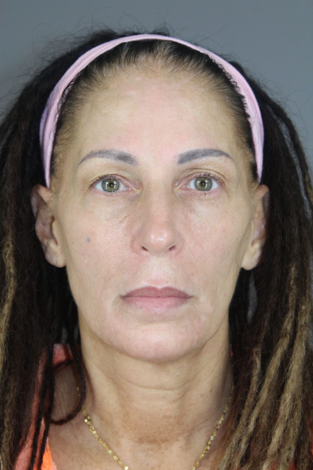 Eyelid Surgery Before & After