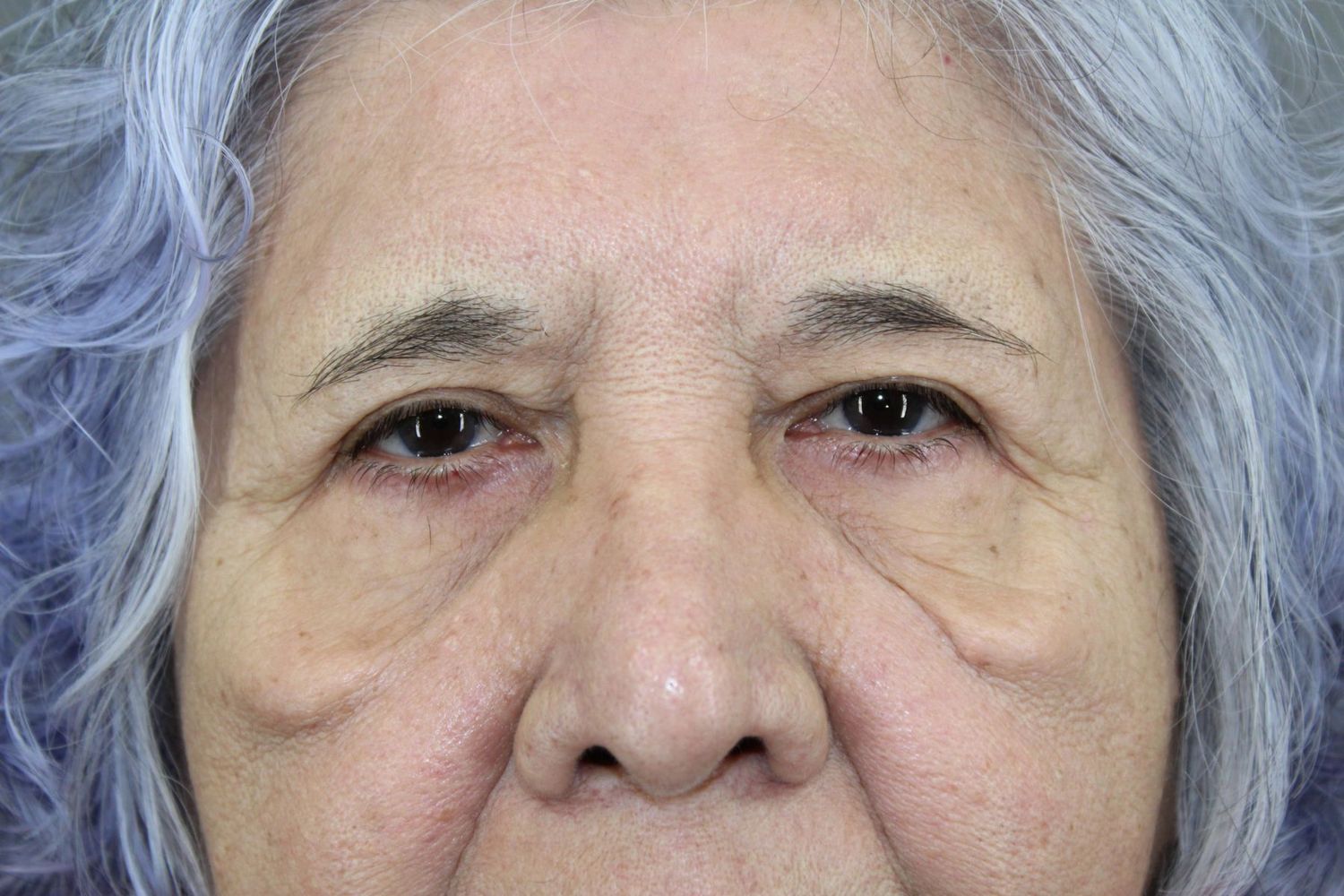 Eyelid Surgery Before & After