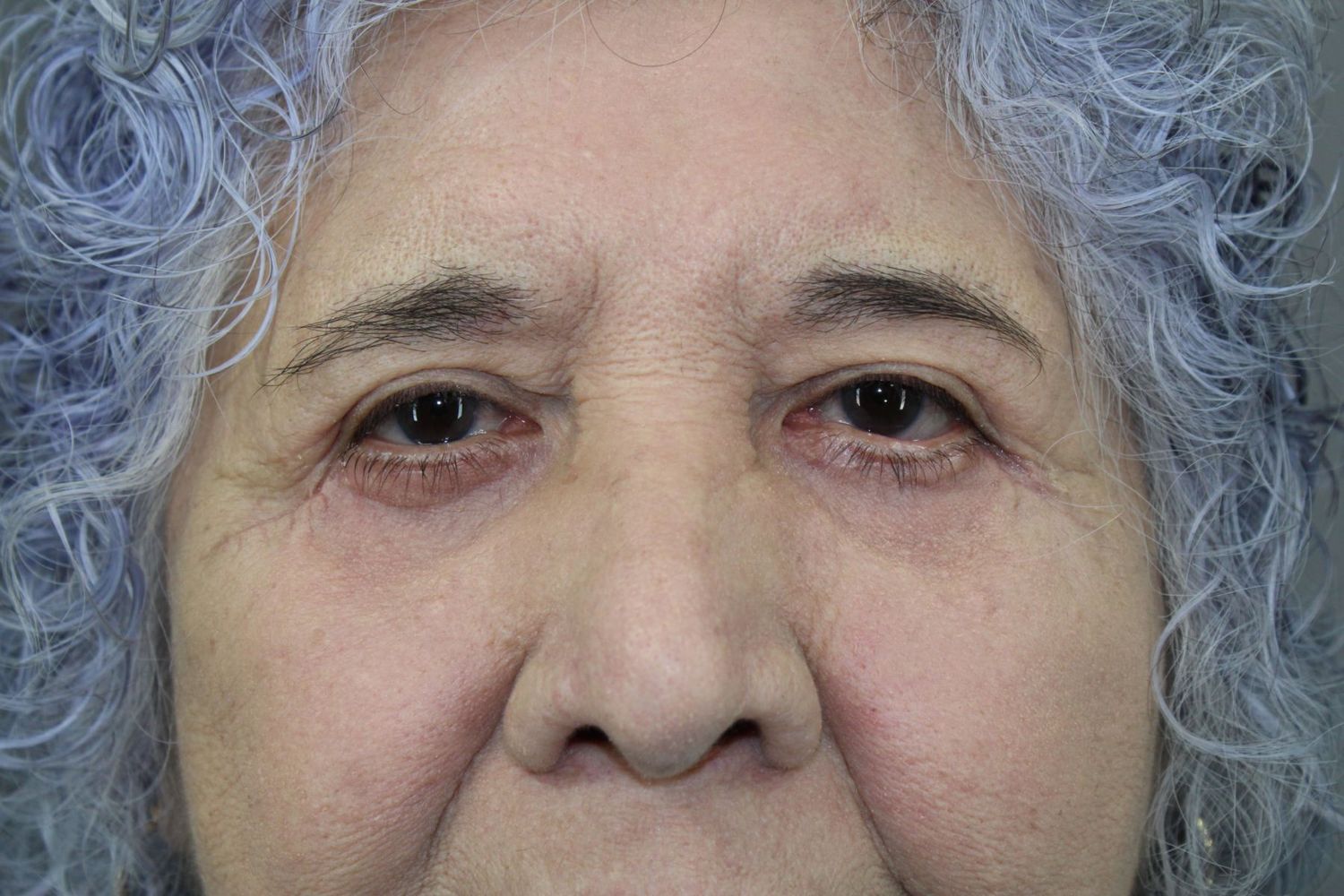 Eyelid Surgery Before & After