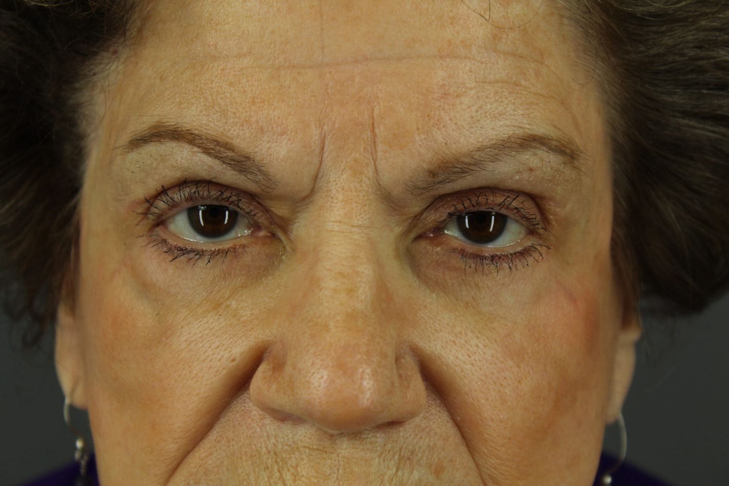 Eyelid Surgery Before & After