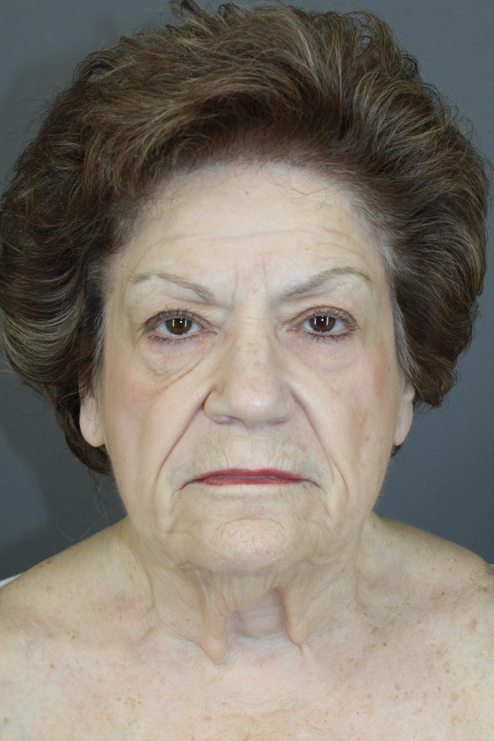 Eyelid Surgery Before & After