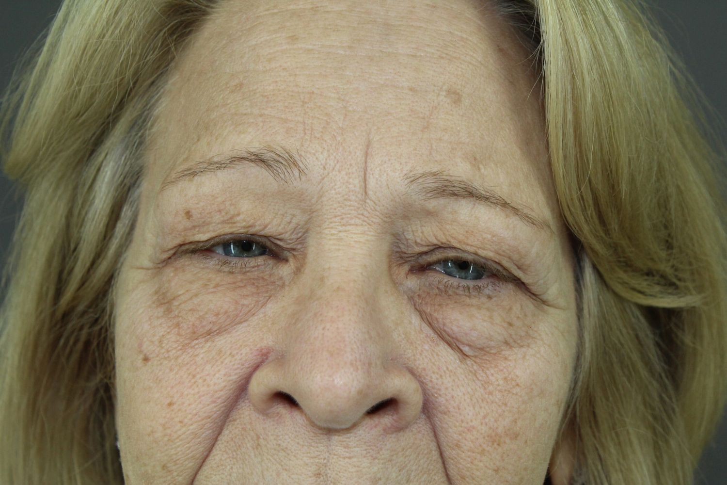 Eyelid Surgery Before & After