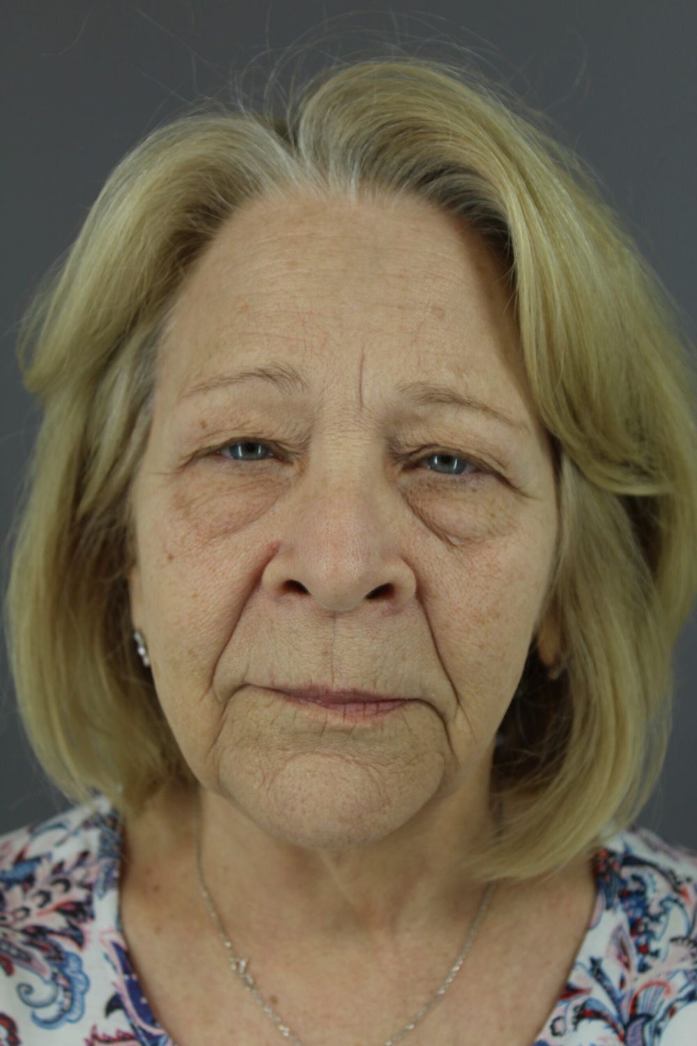 Eyelid Surgery Before & After