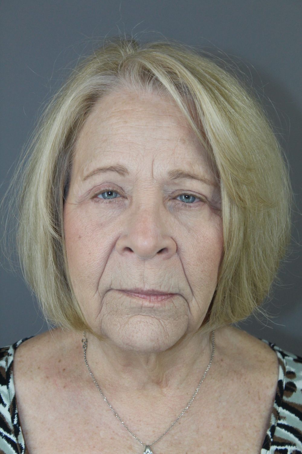 Eyelid Surgery Before & After