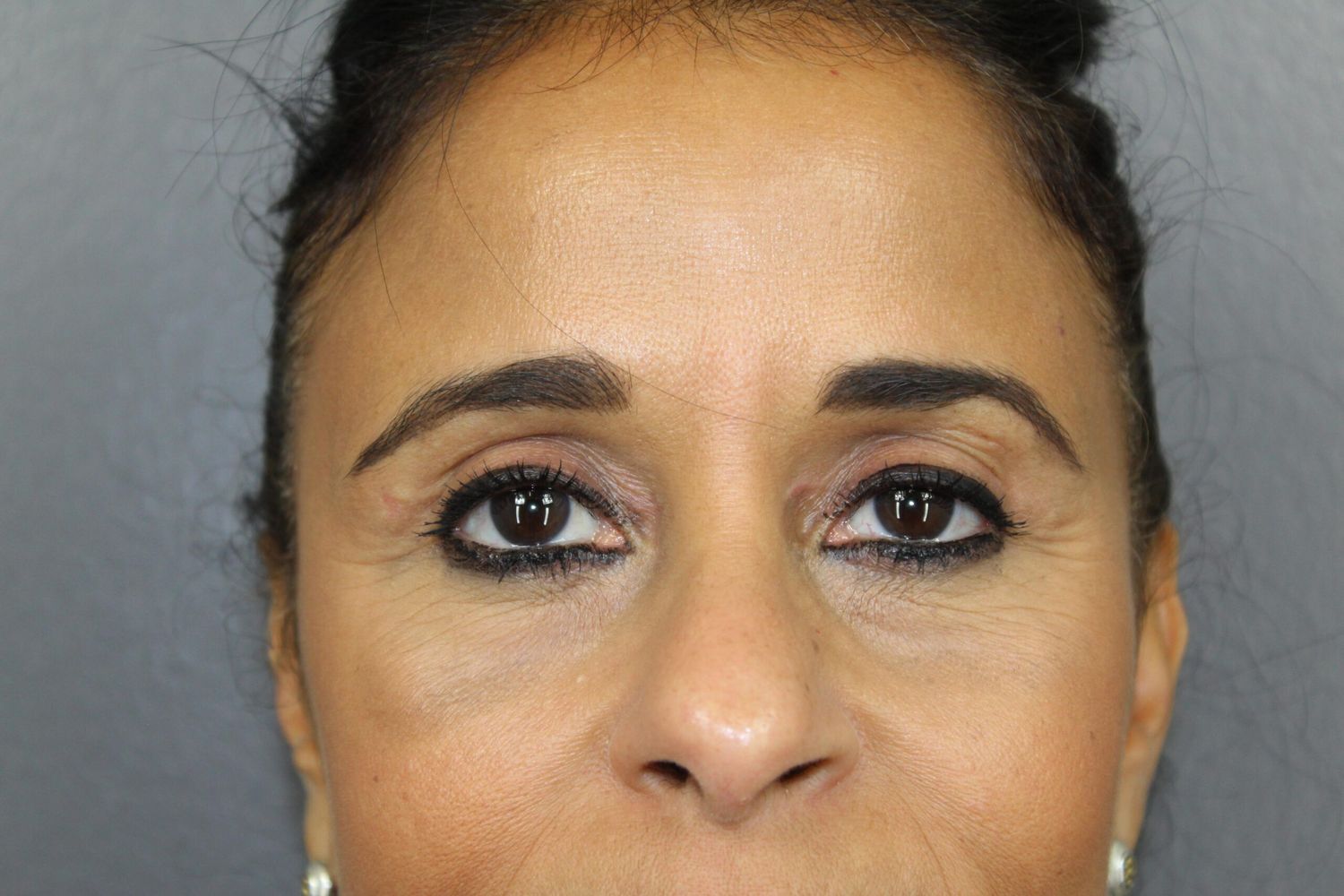 Eyelid Surgery Before & After