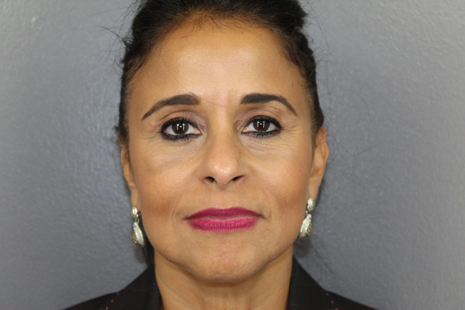 Eyelid Surgery Before & After