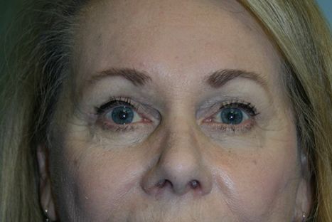 Eyelid Surgery Before & After