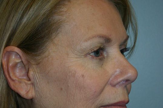 Eyelid Surgery Before & After