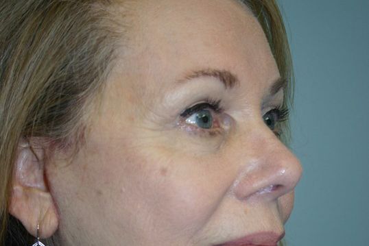 Eyelid Surgery Before & After