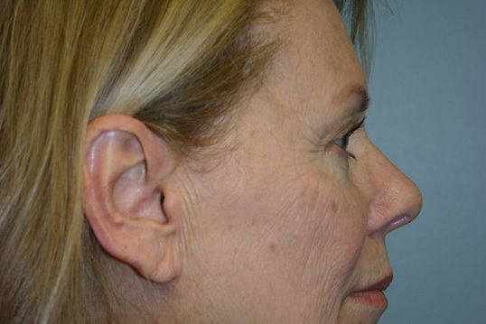 Eyelid Surgery Before & After