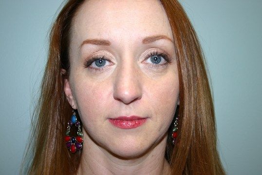 Eyelid Surgery Before & After