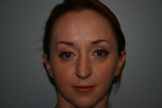 Eyelid Surgery Before & After