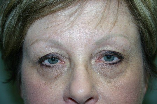 Eyelid Surgery Before & After