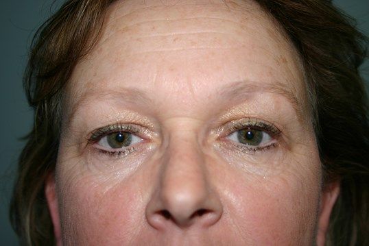 Eyelid Surgery Before & After
