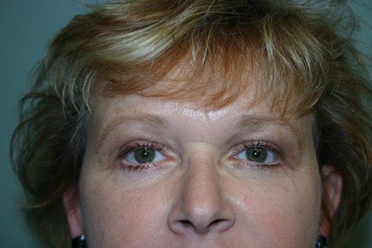 Eyelid Surgery Before & After