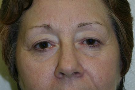 Eyelid Surgery Before & After