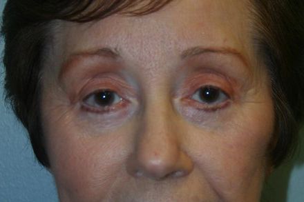 Eyelid Surgery Before & After