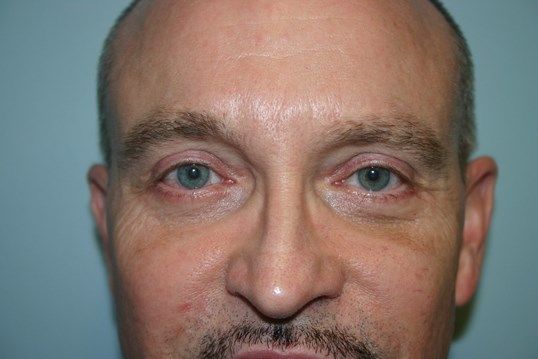 Eyelid Surgery Before & After