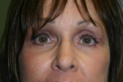 Eyelid Surgery Before & After