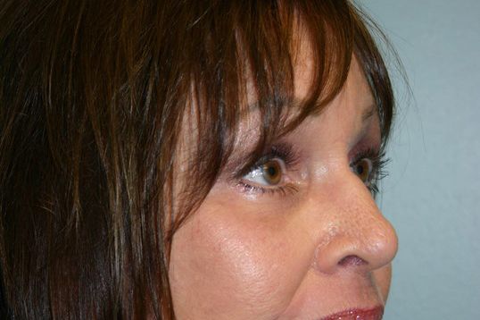 Eyelid Surgery Before & After