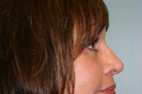 Eyelid Surgery Before & After