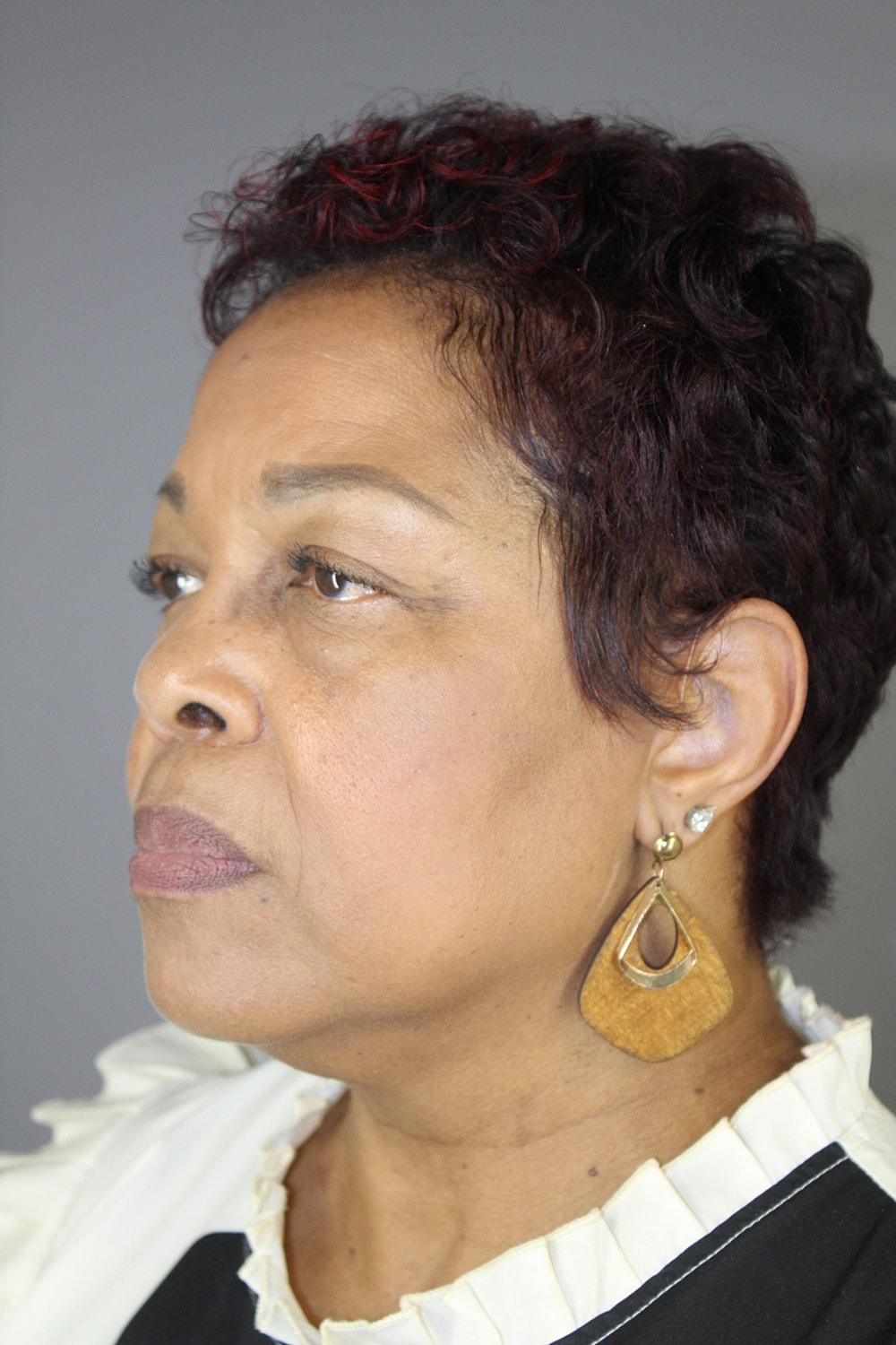 Eyelid Surgery Before & After