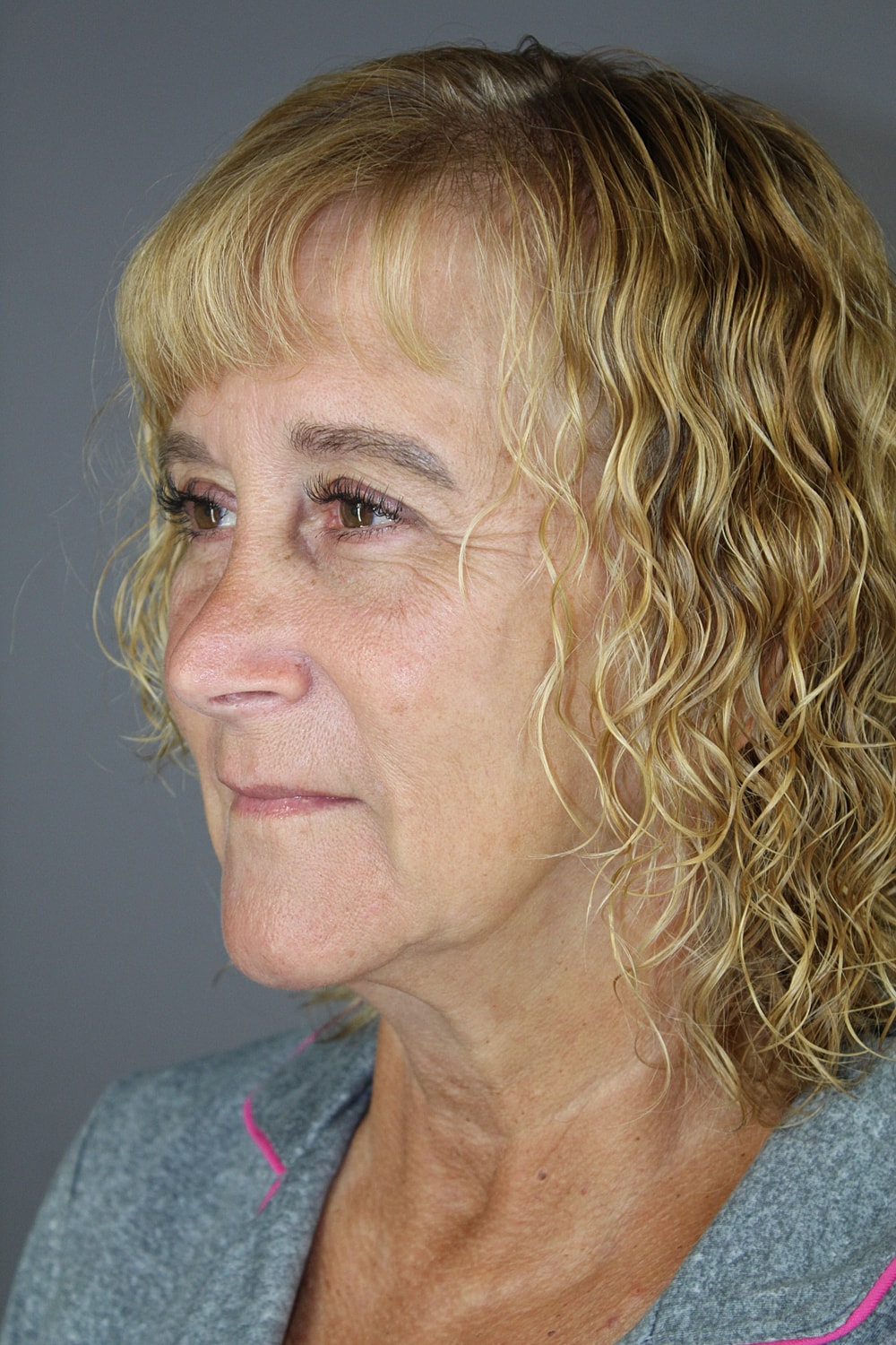 Eyelid Surgery Before & After