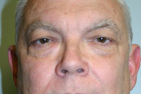 Eyelid Surgery Before & After