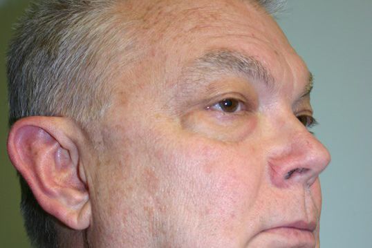 Eyelid Surgery Before & After